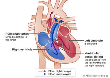 Heart showing pulmonary artery with extra blood flow to lungs, enlarged left ventricle, right ventricle, and a hole between ventricles allowing blood to flow from left to right ventricle.