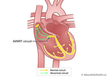 Abnormal circuit in right atrium goes backward with accessory pathway over AV node causing fast heart rate.