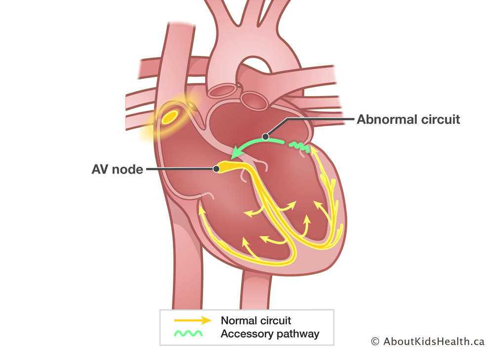 Heart with accessory pathway and abnormal circuit in left atrium leading back to AV node causing fast heart rate.