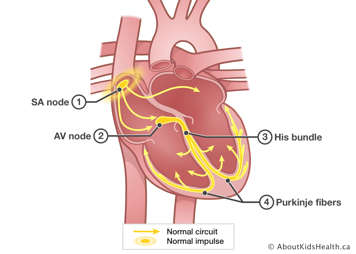 Normal heart showing placement of the SA node, AV node, His bundle and Purkinje fibers