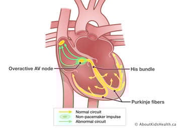 Overactive AV node causes non-pacemaker impulse at AV node, results in abnormal circuit up to SA node.