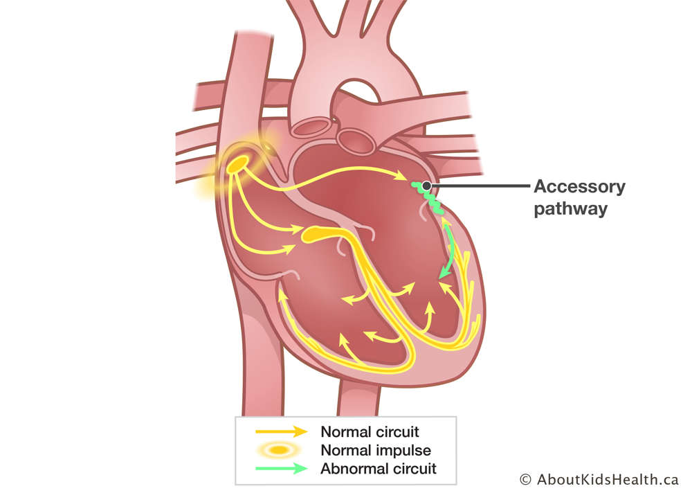 Accessory pathway from left atrium to Purkinje fibers causes abnormal circuit next to normal circuit in Purkinje fibers.