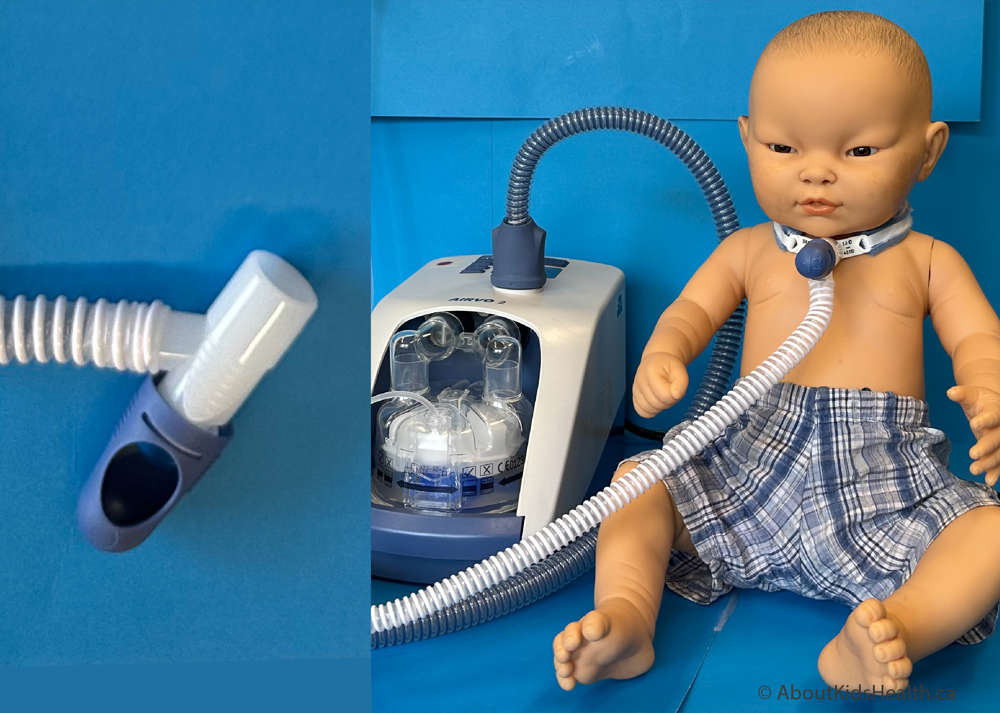 child with a heated high flow humidifier tracheostomy adaptor and an inset showing a close up of a heated high flow humidifier tracheostomy adaptor