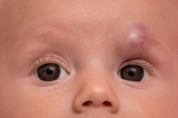 Round purplish swelling under the skin at the front or inner half of a baby's eyebrow