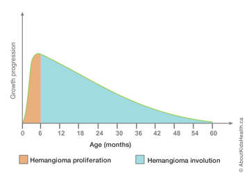 Graph relating age in months to hemangioma growth, with proliferation between 0 and 4 months and involution between 4 and 6 months