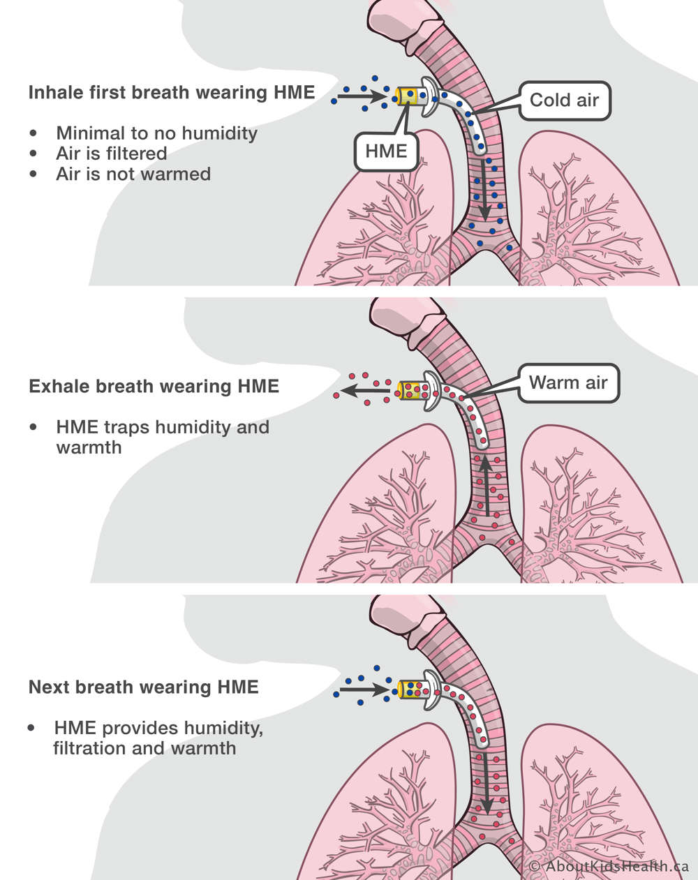 How an HME works showing how humidity and warmth is trapped