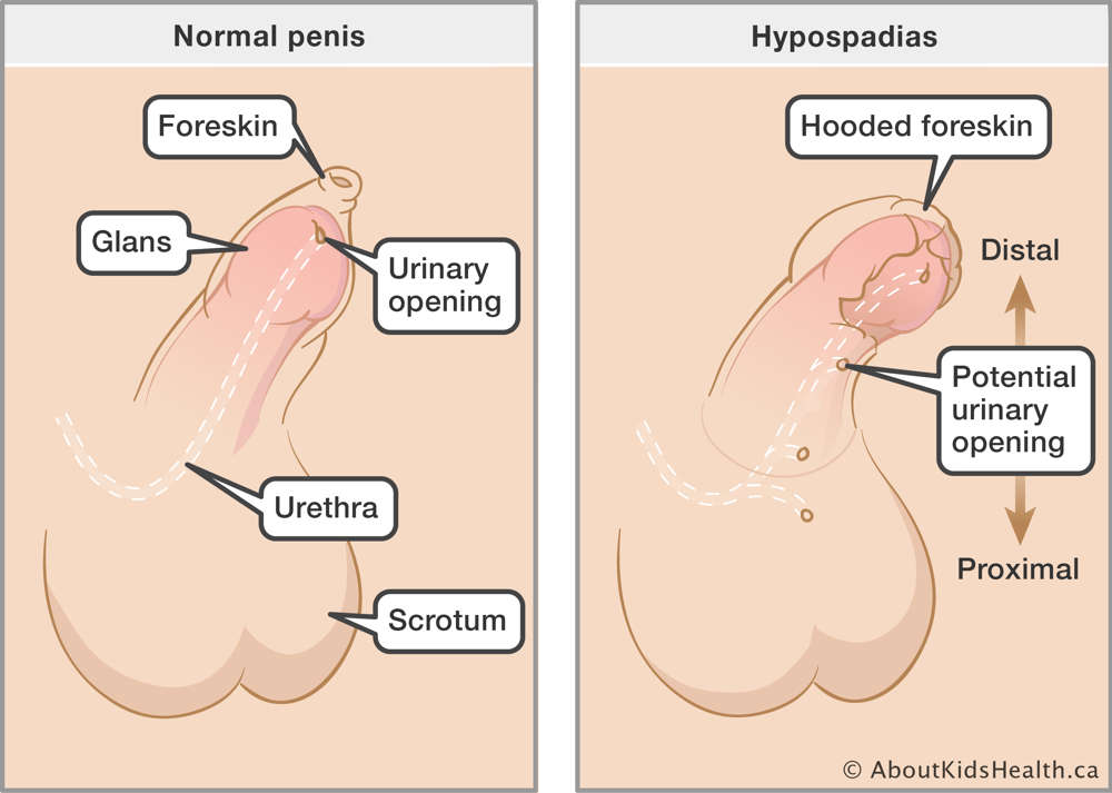Identification of the meatus (opening), foreskin, glans, urethra and scrotum in a normal penis and a penis with hypospadias