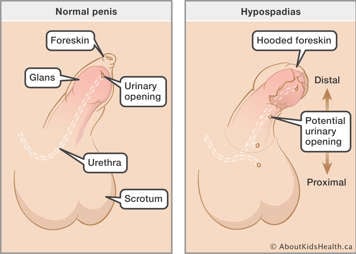 Identification of the meatus (opening), foreskin, glans, urethra and scrotum in a normal penis and a penis with hypospadias