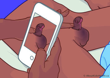 Smartphone camera held beside a child lying on their back to get side view of penis. A finger holds the penis up at the base