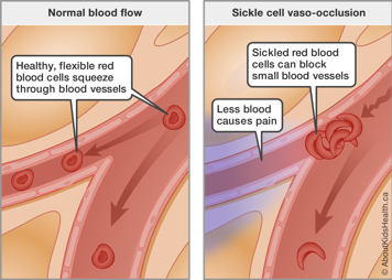 Sickled red blood cells can block small blood vessels, and less blood causes pain