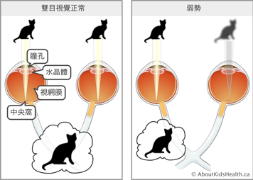 弱視示意圖:從右眼看到的貓非常清晰,而左眼看到的貓是模糊的