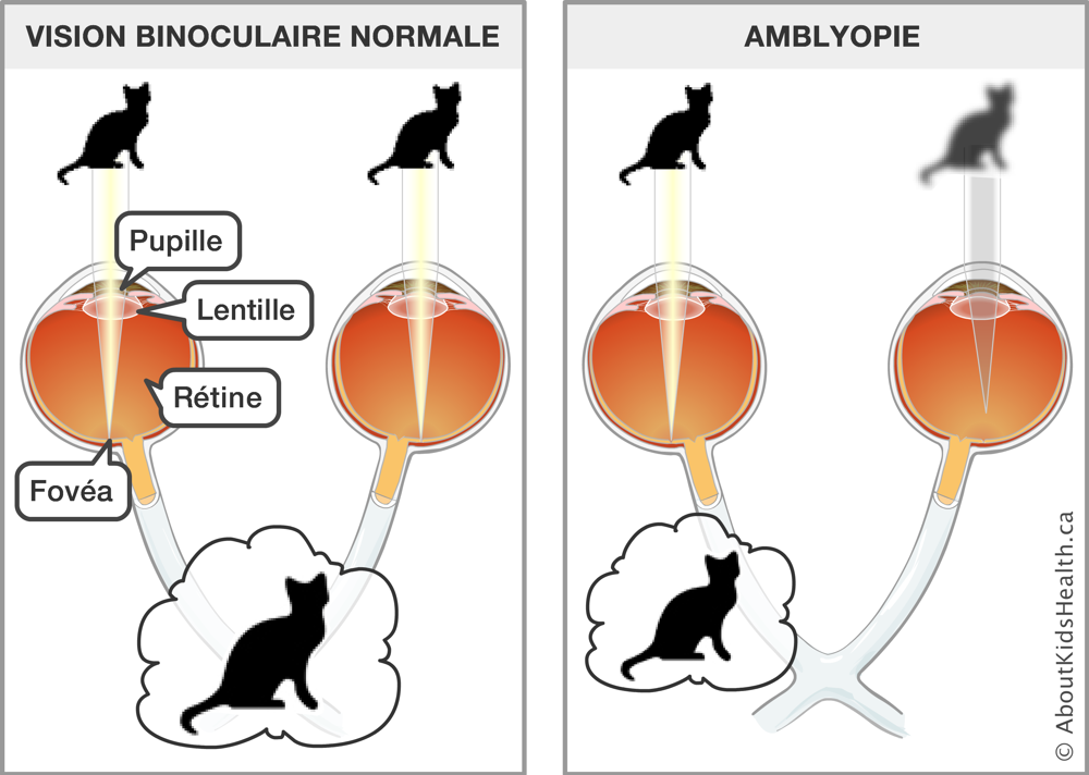 L’amblyopie est démontrée par une image floue d’un chat devant l’œil droit et une image claire d’un chat devant l’œil gauche