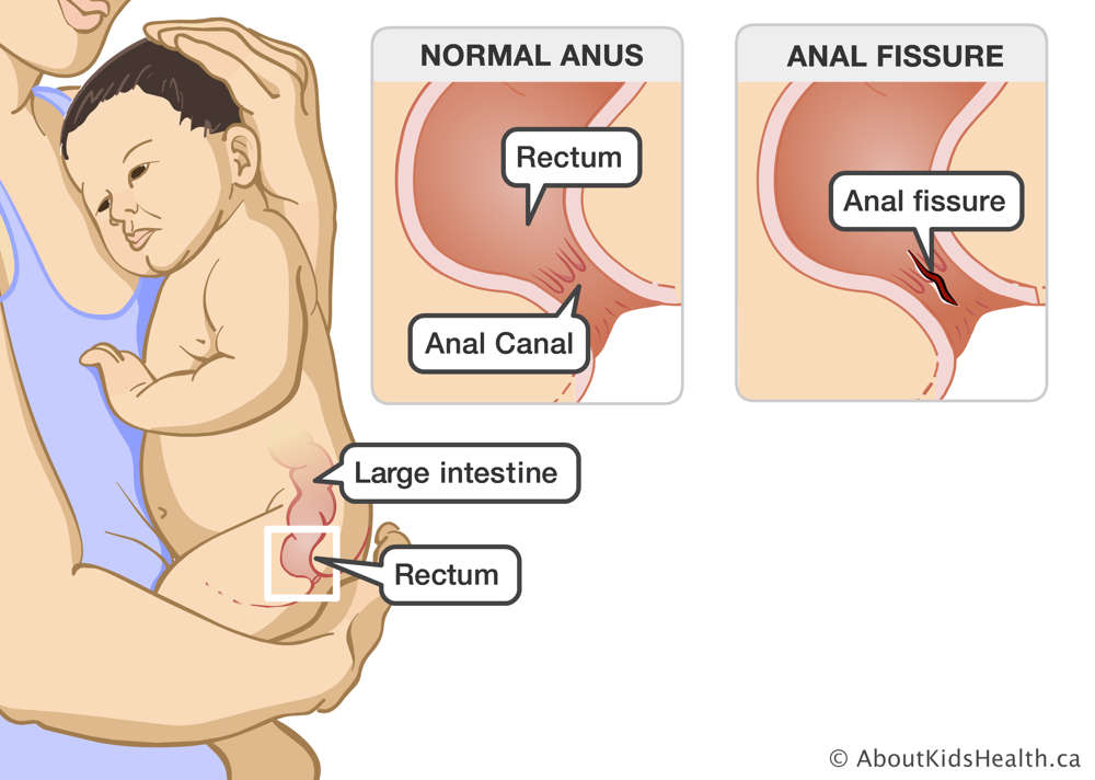 The large intestine and rectum in a baby, a normal anus with clear rectum and anal canal, and an anus with a tear