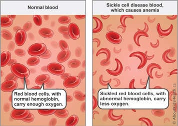 Red blood cells with normal hemoglobin carry enough oxygen—sickled red blood cells with abnormal hemoglobin carry less oxygen