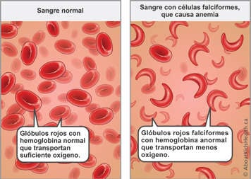 Red blood cells with normal hemoglobin carry enough oxygen—sickled red blood cells with abnormal hemoglobin carry less oxygen