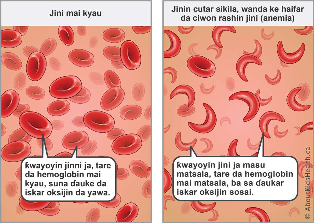 Red blood cells with normal hemoglobin carry enough oxygen&mdash;sickled red blood cells with abnormal hemoglobin carry less oxygen