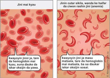 Red blood cells with normal hemoglobin carry enough oxygen—sickled red blood cells with abnormal hemoglobin carry less oxygen
