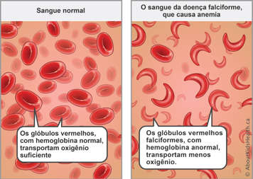 Red blood cells with normal hemoglobin carry enough oxygen—sickled red blood cells with abnormal hemoglobin carry less oxygen