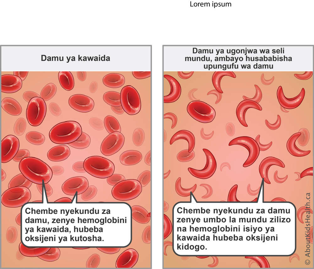 Red blood cells with normal hemoglobin carry enough oxygen&mdash;sickled red blood cells with abnormal hemoglobin carry less oxygen