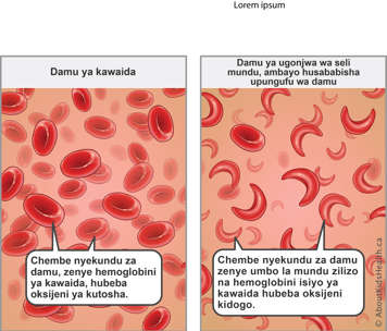 Red blood cells with normal hemoglobin carry enough oxygen—sickled red blood cells with abnormal hemoglobin carry less oxygen