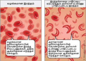 Red blood cells with normal hemoglobin carry enough oxygen—sickled red blood cells with abnormal hemoglobin carry less oxygen