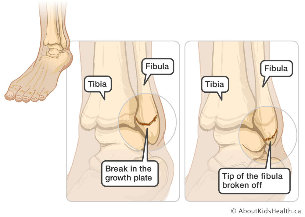 Ankle with break in the growth plate and ankle with tip of the fibula broken off