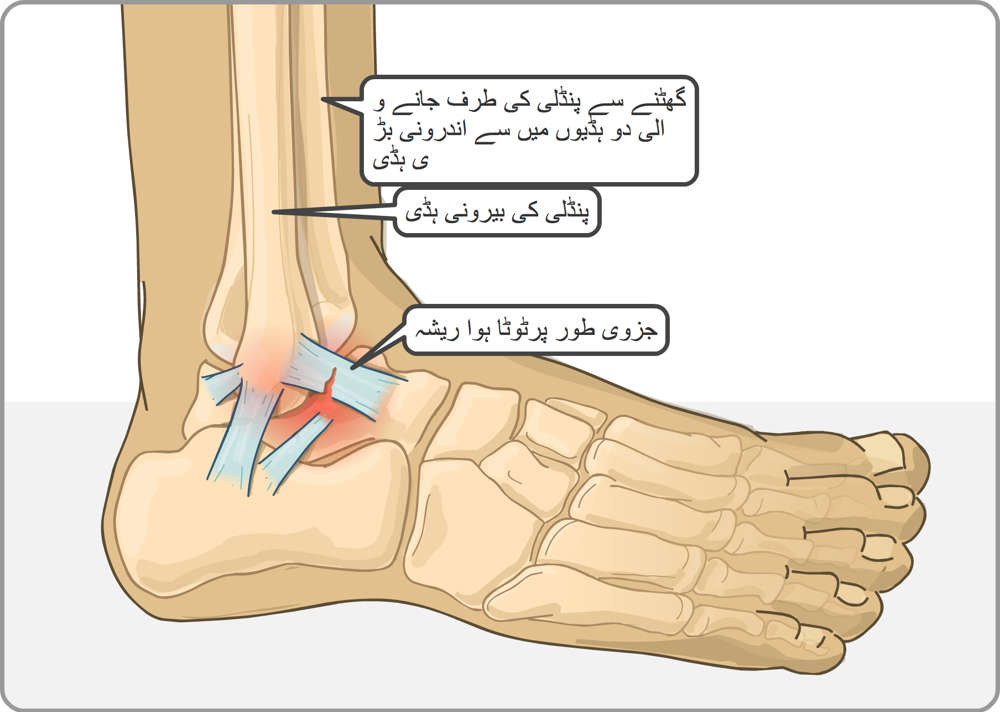 ٹخنے میں ٹیبیا، سنگ قفلی اور جزوی طور پر ٹوٹی ہوئی ریشہ دار نسیج کی پٹی
