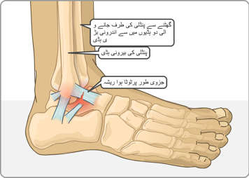 ٹخنے میں ٹیبیا، سنگ قفلی اور جزوی طور پر ٹوٹی ہوئی ریشہ دار نسیج کی پٹی