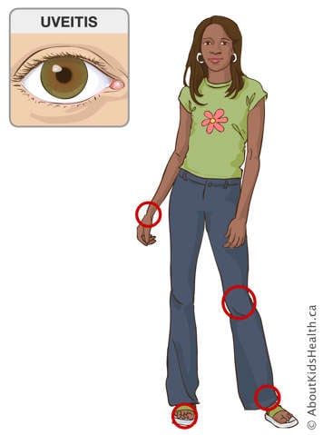 Identification of the wrist, knee, ankle and toe joints on a girl’s body, and illustration of an eye affected by uveitis