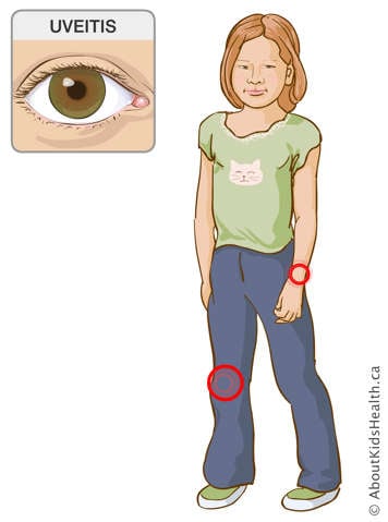Identification of the wrist and knee joints on a girl’s body, and illustration of an eye affected by uveitis