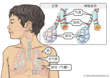 肺、气道和肺泡在人体中的位置分布,以及哮喘发作时气道、肌肉和肺泡的形态