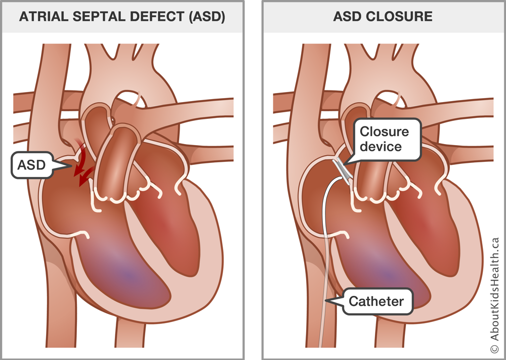 A heart with an atrial septal defect before procedure and a heart with a closure device and catheter