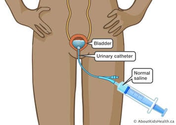 Normal saline being instilled into a female bladder