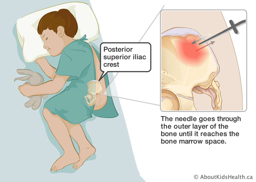 Needle inserted into posterior superior iliac crest until it reaches the bone marrow space