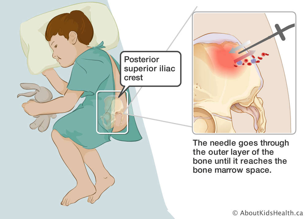 Needle going through the outer layer of the bone to reach the bone marrow space in the posterior superior iliac crest