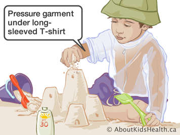 Child wearing pressure garment under long-sleeved t-shirt while playing at the beach