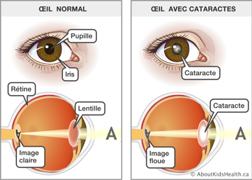 Œil normal voyant une image claire et œil avec cataracts voyant une image floue
