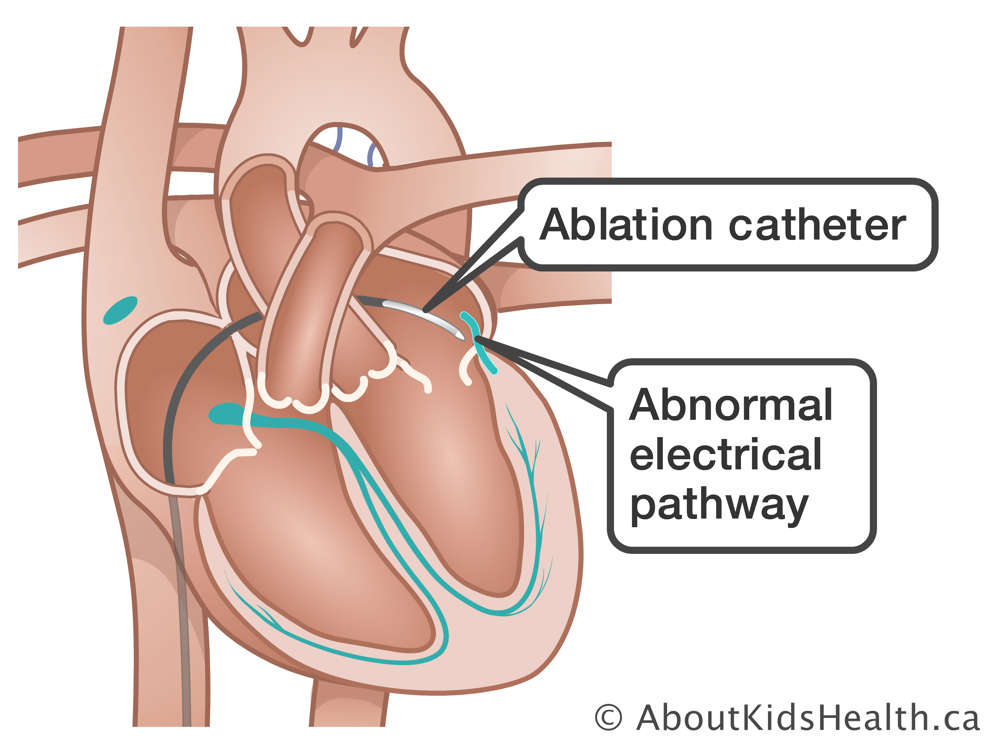 A heart with an ablation catheter inserted and an abnormal electrical pathway