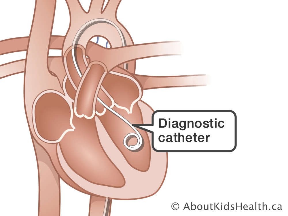 Illustration of a diagnostic catheter in the heart