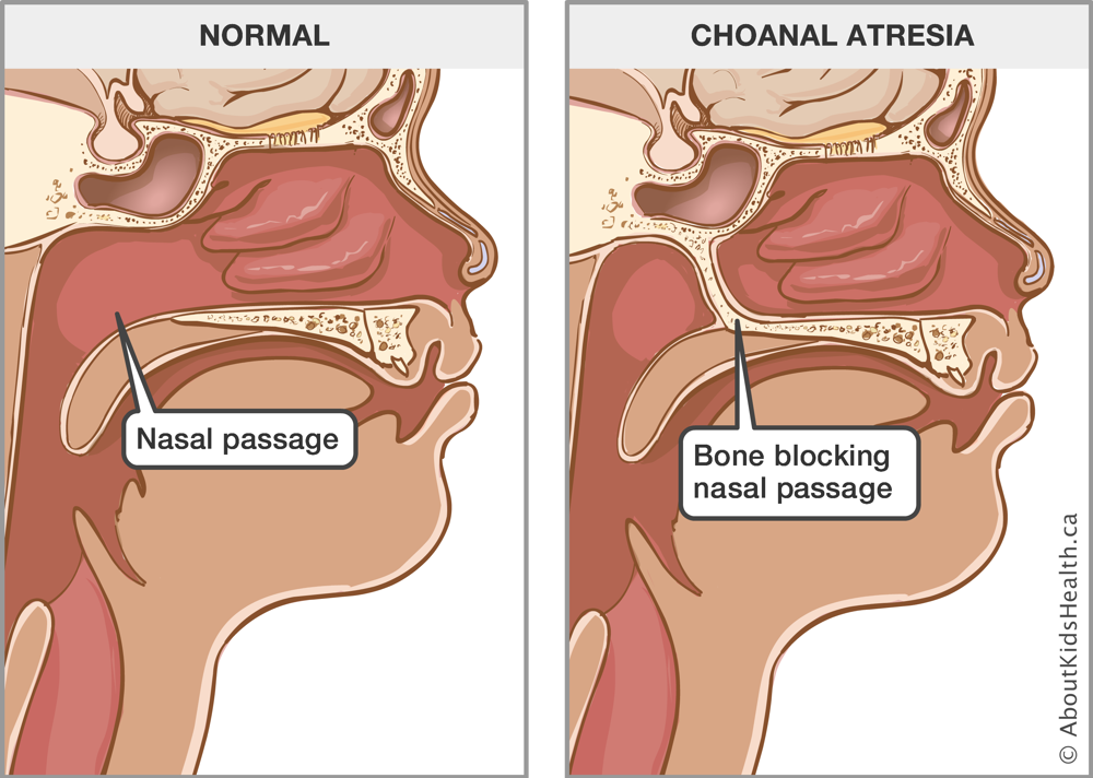A normal nasal passage and a nasal passage with choanal atresia