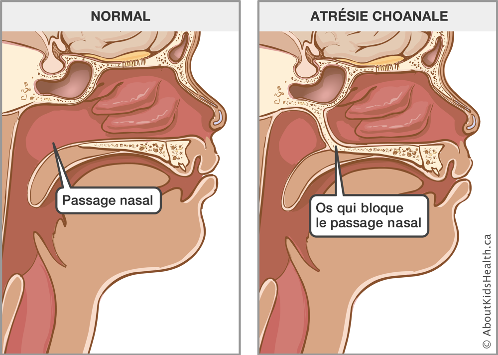 Un passage nasal normal et un passage nasal avec l’atrésie choanale