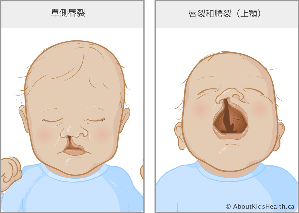 唇裂至鼻底的嬰兒，以及唇齶裂的嬰兒