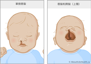 唇裂至鼻底的嬰兒,以及唇齶裂的嬰兒