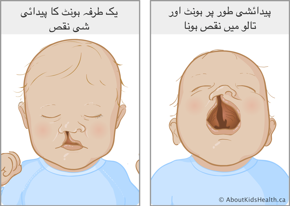 ہونٹ میں ناک تک شگاف والا بچہ اور ایک کھلے ہوئے منہ والا بچہ جو ہونٹ میں شگاف اور منہ کی چھت کو ظاہرکر رہا ہے
