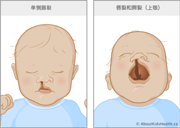 唇裂至鼻底的婴儿,以及唇腭裂的婴儿