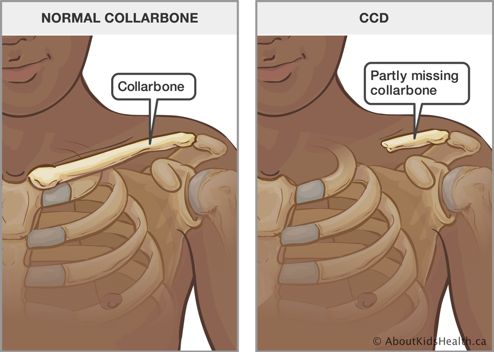 Upper body with normal collarbone and an upper body with partly missing collarbone