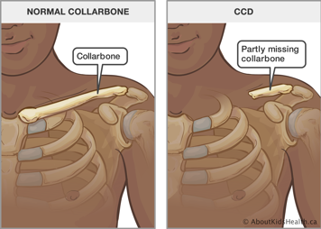 Upper body with normal collarbone and an upper body with partly missing collarbone