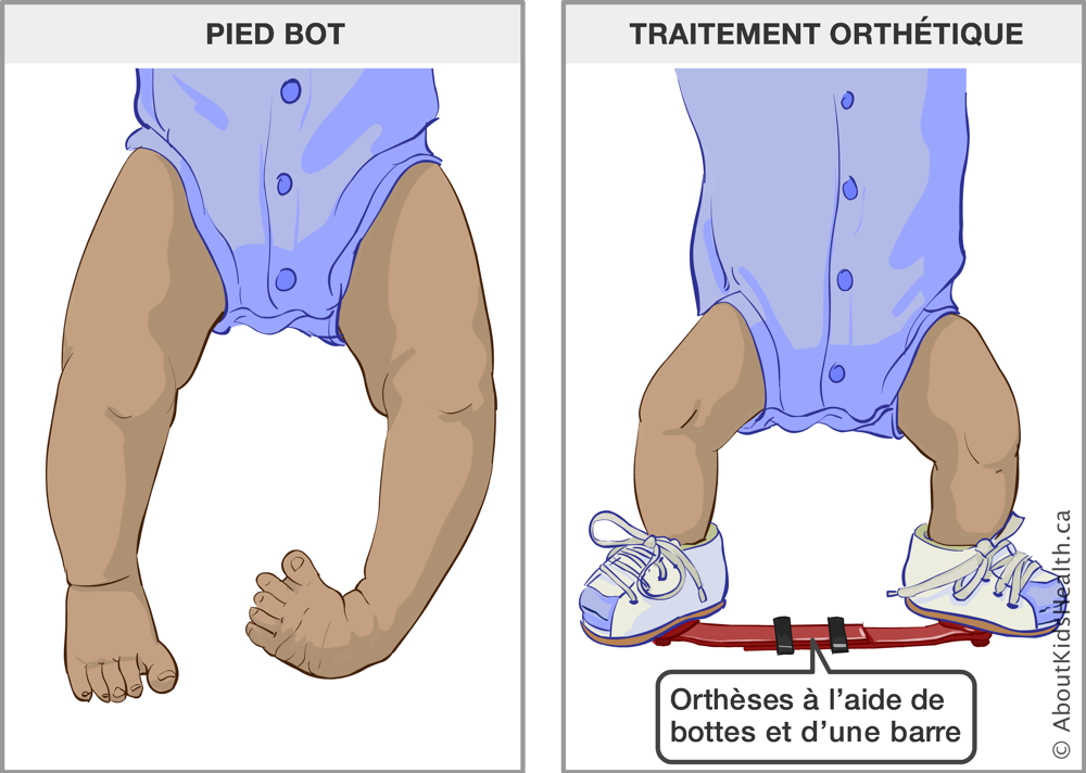 Bébé avec pied bot et bébé portant des orthèses à l’aide de bottes et d’une barre