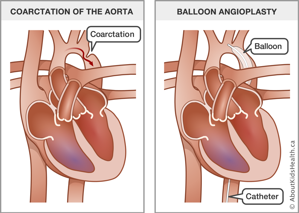 Illustration of coarctation of the aorta and of balloon angioplasty