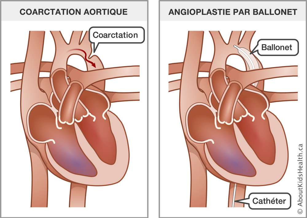 Un cœur avec une coarctation aortique à côté d'un cœur avec un ballonnet et un cathéter insérés